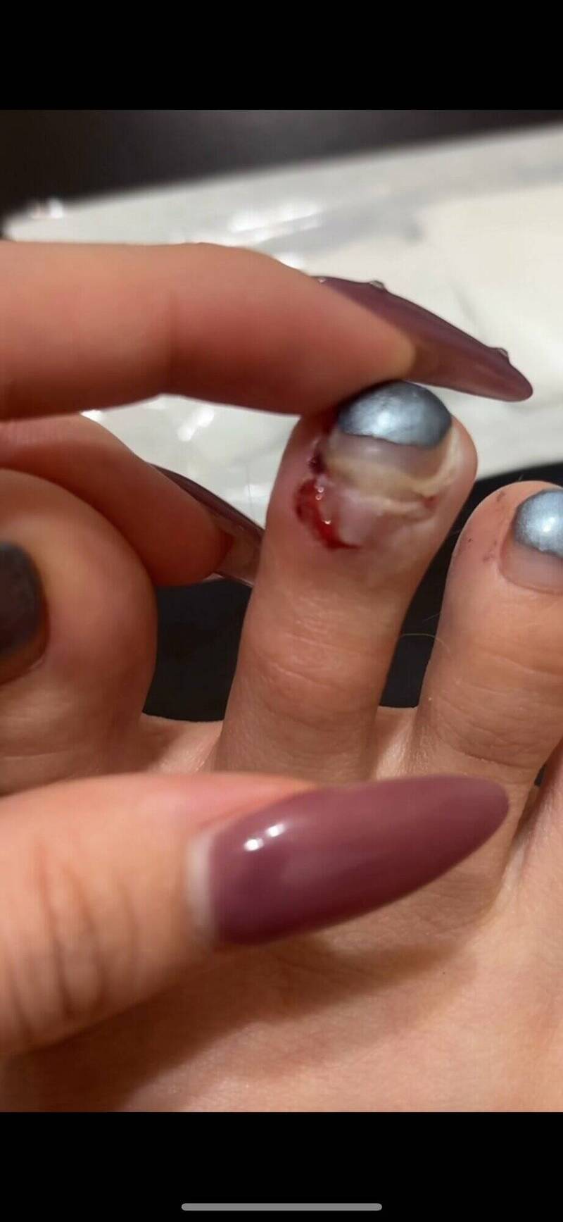 新竹市王小姐騎YouBike遭惡霸犬攻擊咬斷腳趾甲，向飼主求償15萬，未獲誠意回應，決定提告捍衛權益。（王小姐提供）